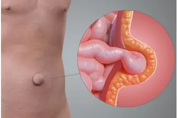 Göbek Fıtığı Yırtılması Belirtileri ve Tedavisi