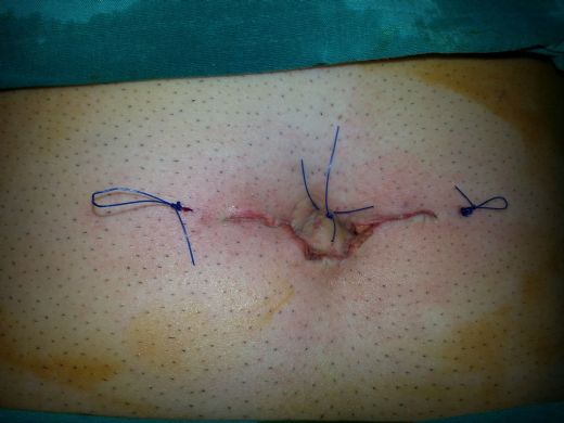 Ameliyat Sonrası Göbek Fıtığı Belirtileri ve Tedavisi