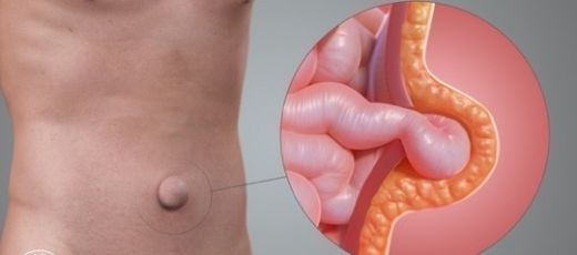 Göbek Fıtığı Karın Ağrısı Yapar mı?